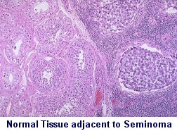 Microscopic Image of Normal Testicular Tissue adjacent to Seminoma
