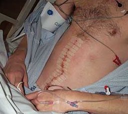 Tom Green's RPLND incision